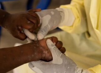 Brasil registra 88 casos de Mpox em 2026; São Paulo lidera com 62 ocorrências