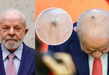 Lula inicia radioterapia após retirada de câncer de pele